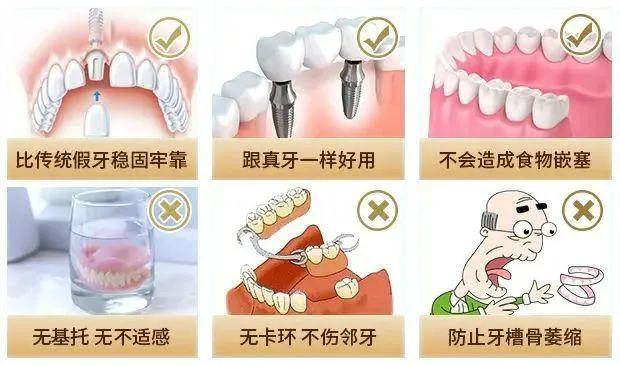 几乎无牙的李叔，植入几颗植体后，稳固好牙全“长”出来了！