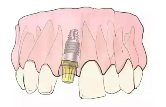 到底什么是种牙——史上最简单明了的种植牙说明来啦