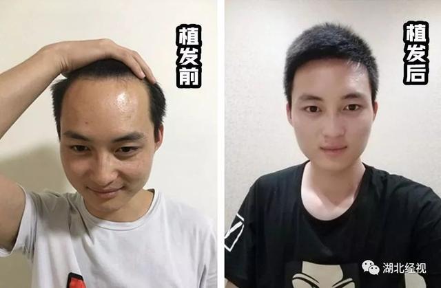 98后都秃了？含泪整理！湖北脱发秃顶、发际线高“自救指南”了解一下……