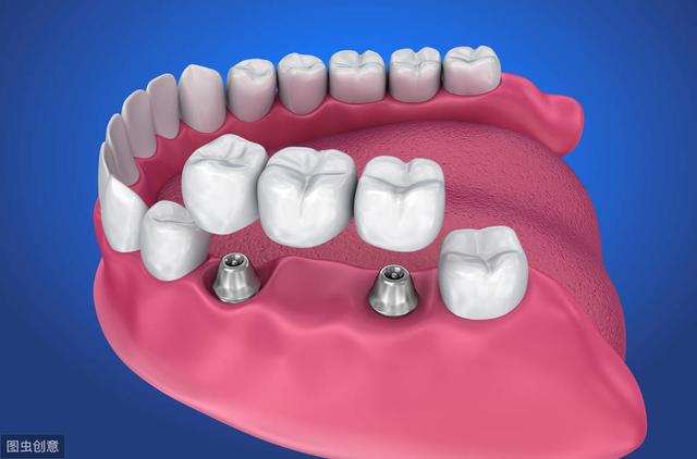 2000块的种植体你真的敢种吗？为什么会这么便宜，良心牙医告诉你