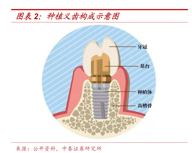 种植牙：集采是契机还是噩耗？