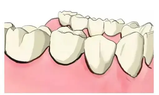到底什么是种牙——史上最简单明了的种植牙说明来啦