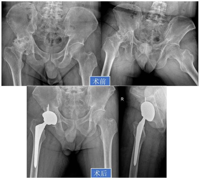 「视频」股骨头坏死：保髋or换髋？看这篇就够了