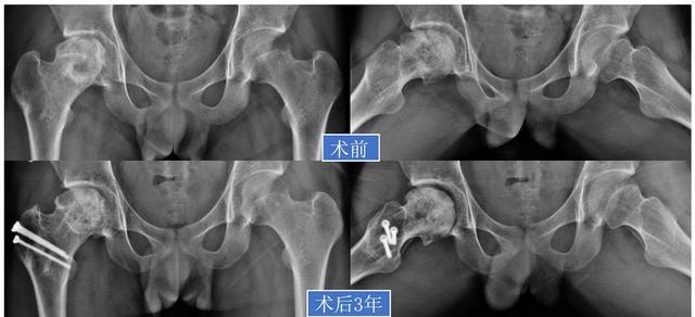 「视频」股骨头坏死：保髋or换髋？看这篇就够了