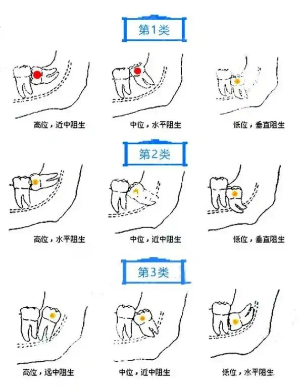 智齿是磨牙坏了才长出来的吗？