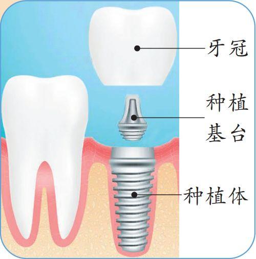 一颗牙成千上万！口腔专家告诉你「种牙」到底贵在哪里