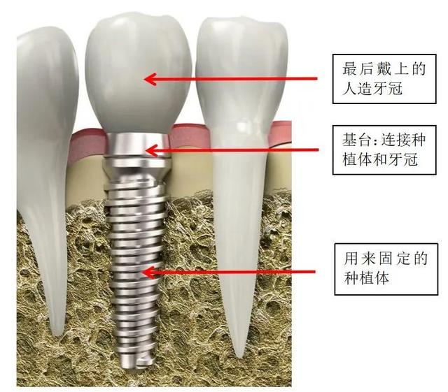 种一颗牙动辄上万，集采后能实现种牙自由吗？