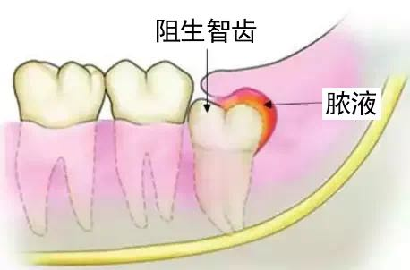 智齿是磨牙坏了才长出来的吗？