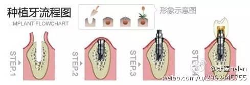 Helen齿科中心——烤瓷牙、种植牙能用多久？