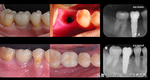 口腔医生绝对不会告诉你种植牙过程中的几点“秘密”