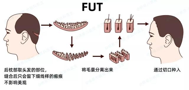 植发的发是从何处而来...