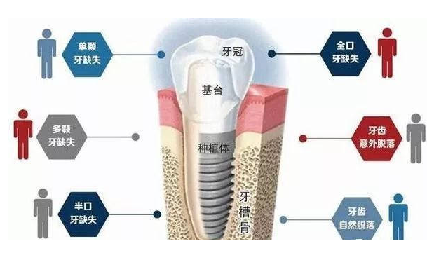 种植牙虽好，但是有利就会有弊！听听医生怎么说