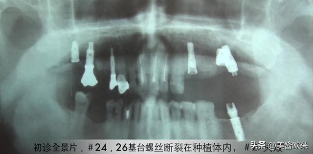 种植牙内幕揭露！上至几千下至几百的种植体哪个好？医院咋选？