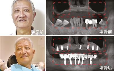 骨增量技术或有重大突破 高龄老人也能安全种好牙