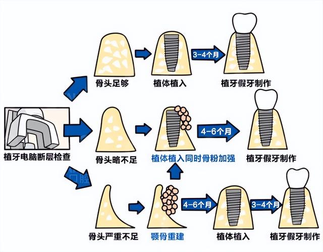 种牙前为什么要植骨？骨粉究竟是什么东西？