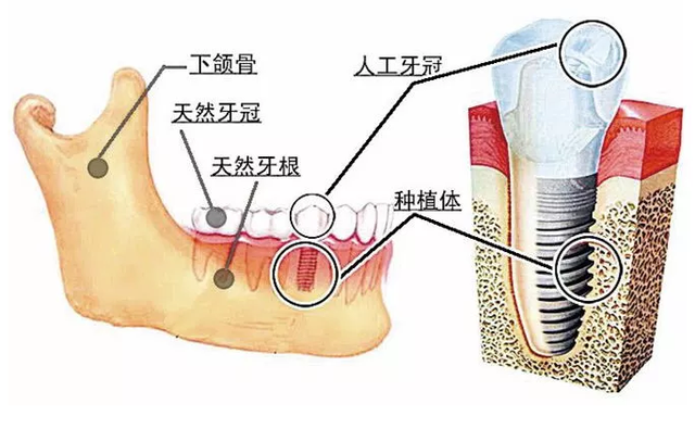 大连齿医生口腔科普 种植牙的术前术后 我们应该做些什么