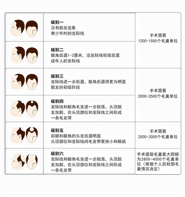 植发大概要多少钱？准备植发的朋友建议读完