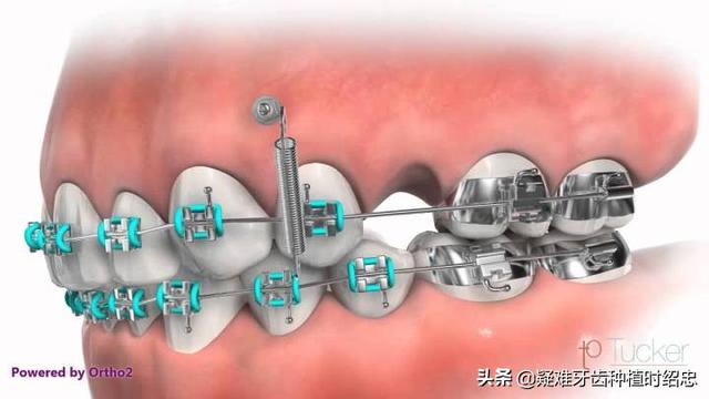 如果说拔牙是被砍一刀，那打支抗钉就相当于被扎一针