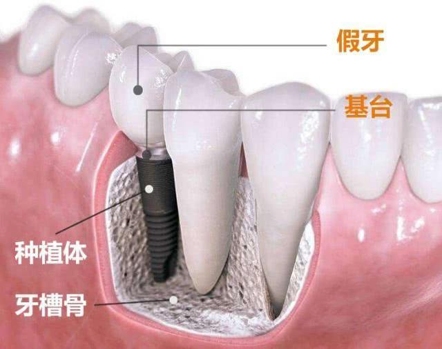 种植牙所用的材料是什么？安不安全？种植牙手术后该如何护理？