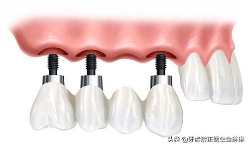 怎么去判断种植牙材料的好坏？教你种植牙怎么选