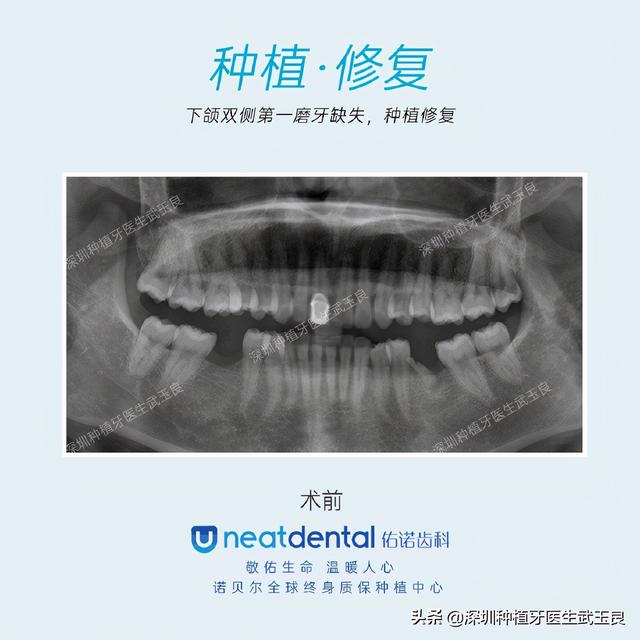 深圳种植牙：磨牙缺失，戴入修复体的种植牙案例解析
