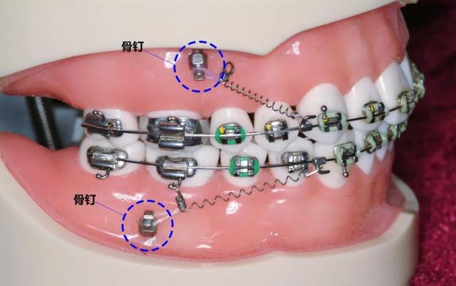 同样用于牙齿正畸，骨钉和附件有什么区别？