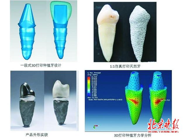 3D打印种植牙要来了！治疗周期缩短治疗费用降低