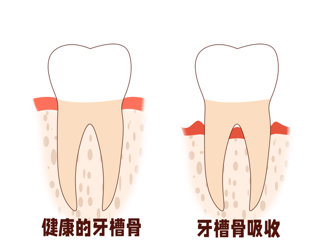 决定种植牙的成功率，牙槽骨为何如此重要？