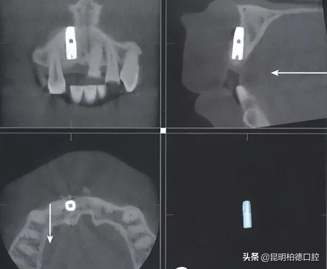 种植牙的材质是什么？看完都能放心种牙了