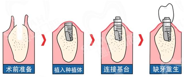 种一颗牙到底贵在哪里？种牙前，医生想告诉你的6件事