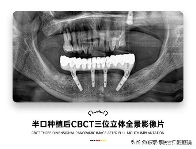 一颗种植牙从一千多到上万元，到底需要花多少钱？