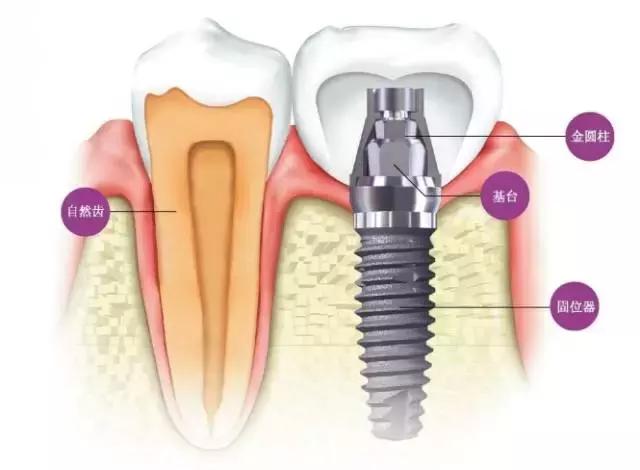 两千？两万？种植牙该怎么选？！