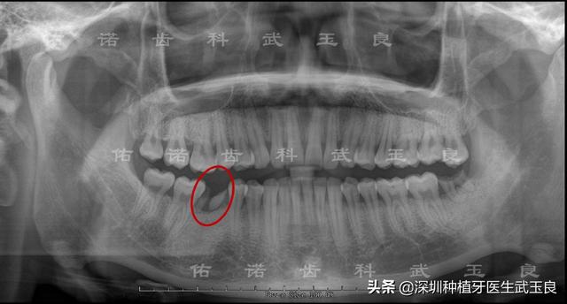 深圳种植牙：年度经典种植牙案例之牙齿龋坏，奥齿泰植体篇