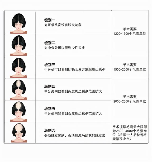 植发大概要多少钱？准备植发的朋友建议读完