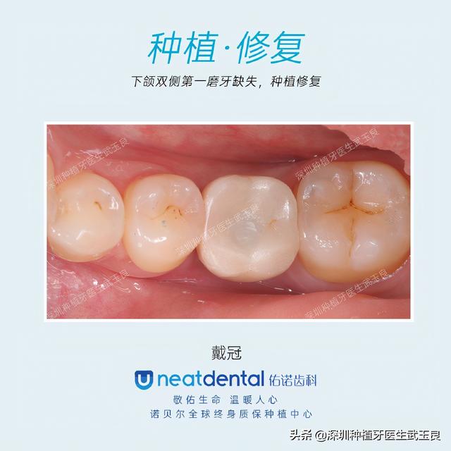 深圳种植牙：磨牙缺失，戴入修复体的种植牙案例解析