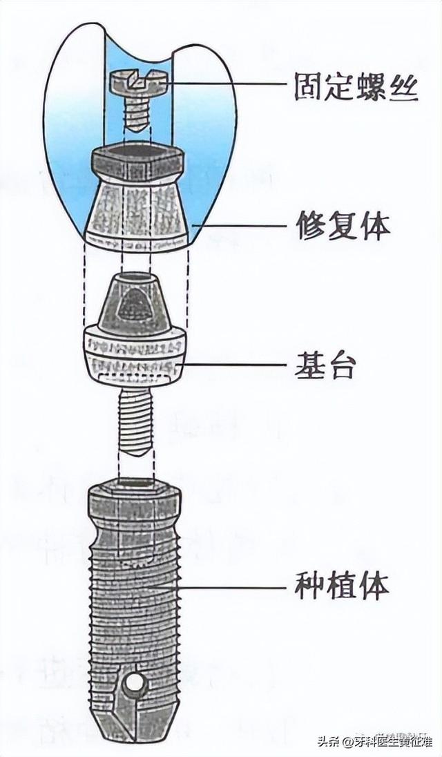 1分钟了解种植牙到底是个啥（二）