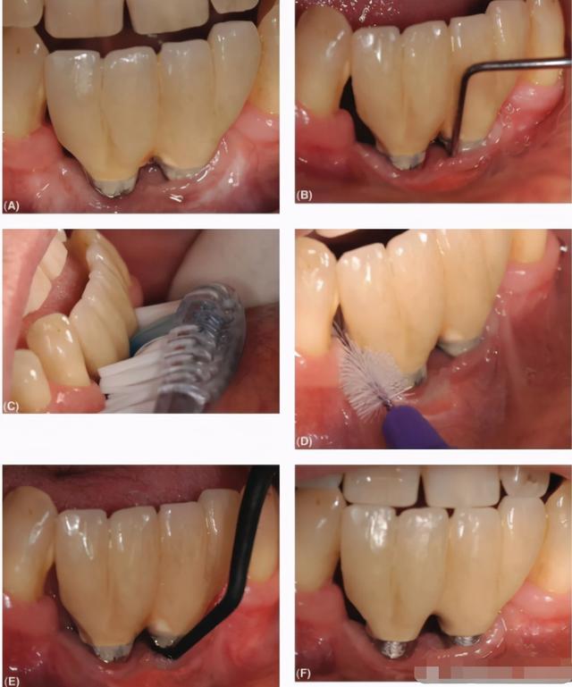对于种植牙的日常维护，患者及医生的操作区别有点大