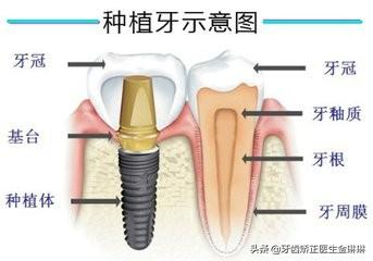 种牙齿疼吗？种植牙疼还是拔牙疼？