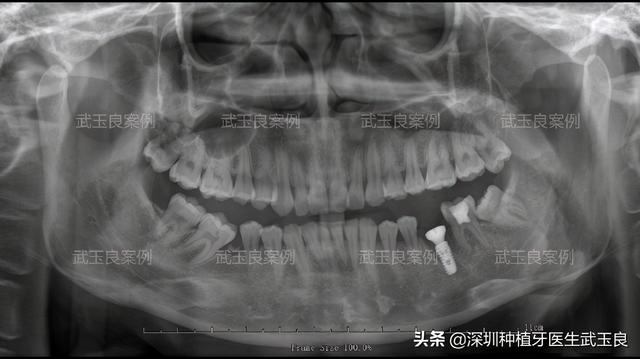 深圳种植牙：年度经典种植牙案例之牙齿龋坏，奥齿泰植体篇