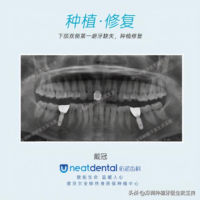 深圳种植牙：磨牙缺失，戴入修复体的种植牙案例解析