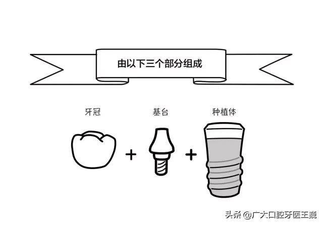 想要种牙的！聪明的人都是这样选植体的