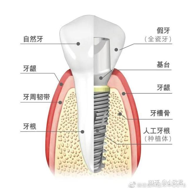 种植基台的选择