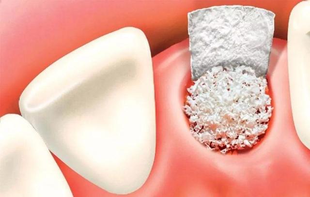 冷知识：你猜种植牙植骨粉一次多少钱？按克收费堪比黄金