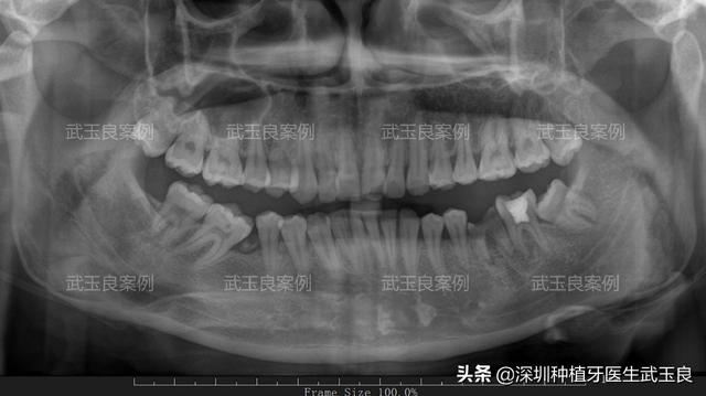 深圳种植牙：年度经典种植牙案例之牙齿龋坏，奥齿泰植体篇