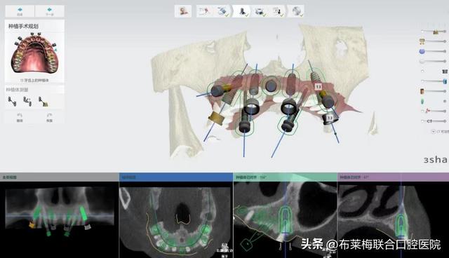 普及率5%不到，数字化种植牙技术为什么不是每个医院都有的？