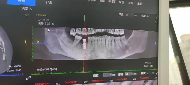 种植牙真的降价了，亲身体验说给大家