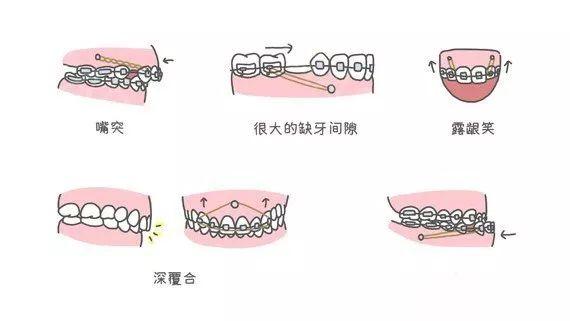 同样用于牙齿正畸，骨钉和附件有什么区别？