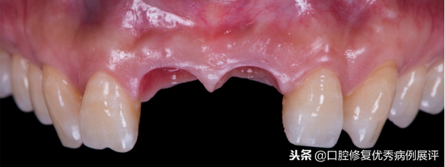 展评优秀病例赏析｜Asc全瓷角度基台一体冠进行种植前牙美学修复