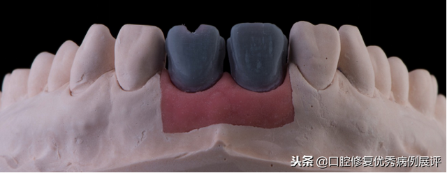 展评优秀病例赏析｜Asc全瓷角度基台一体冠进行种植前牙美学修复