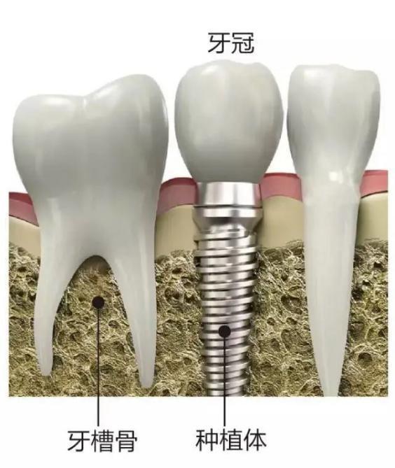 决定种植牙的成功率，牙槽骨为何如此重要？